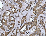 IHC staining of FFPE human oncocytoma of the right kidney tissue with LIMA1 antibody. HIER: boil tissue sections in pH8 EDTA for 20 min and allow to cool before testing.