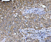 IHC staining of FFPE human lung squamous cell carcinoma tissue with LIMA1 antibody. HIER: boil tissue sections in pH8 EDTA for 20 min and allow to cool before testing.