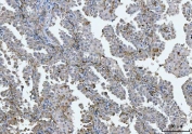 IHC staining of FFPE human lung cancer tissue with BI-1 antibody. HIER: boil tissue sections in pH8 EDTA for 20 min and allow to cool before testing.