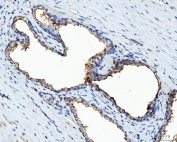 IHC staining of FFPE human prostate cancer tissue with BI-1 antibody. HIER: boil tissue sections in pH8 EDTA for 20 min and allow to cool before testing.