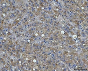 IHC staining of FFPE human liver cancer tissue with BI-1 antibody. HIER: boil tissue sections in pH8 EDTA for 20 min and allow to cool before testing.