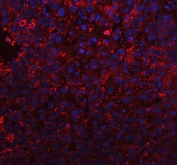 Immunofluorescent staining of FFPE human liver cancer tissue with BI-1 antibody (red) and DAPI nuclear stain (blue). HIER: steam section in pH8 EDTA buffer for 20 min.