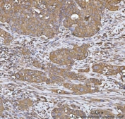 IHC staining of FFPE human appendiceal adenocarcinoma tissue with HO-2 antibody. HIER: boil tissue sections in pH8 EDTA for 20 min and allow to cool before testing.