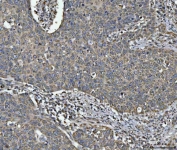IHC staining of FFPE human esophageal squamous carcinoma tissue with NDUFV2 antibody. HIER: boil tissue sections in pH8 EDTA for 20 min and allow to cool before testing.