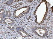 IHC staining of FFPE human colorectal adenocarcinoma tissue with NDUFV2 antibody. HIER: boil tissue sections in pH8 EDTA for 20 min and allow to cool before testing.