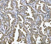 IHC staining of FFPE human lung cancer tissue with NDUFV2 antibody. HIER: boil tissue sections in pH8 EDTA for 20 min and allow to cool before testing.