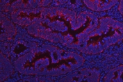 Immunofluorescent staining of FFPE human rectal cancer tissue with NDUFV2 antibody (red) and DAPI nuclear stain (blue). HIER: steam section in pH6 citrate buffer for 20 min.