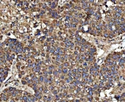 IHC staining of FFPE human liver cancer tissue with 17HSD7 antibody. HIER: boil tissue sections in pH8 EDTA for 20 min and allow to cool before testing.