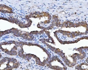 IHC staining of FFPE human prostate cancer tissue with 17HSD7 antibody. HIER: boil tissue sections in pH8 EDTA for 20 min and allow to cool before testing.