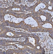 IHC staining of FFPE human colorectal adenocarcinoma tissue with 17HSD7 antibody. HIER: boil tissue sections in pH8 EDTA for 20 min and allow to cool before testing.