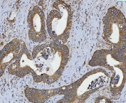 IHC staining of FFPE human colorectal adenocarcinoma tissue with RPL32 antibody. HIER: boil tissue sections in pH8 EDTA for 20 min and allow to cool before testing.