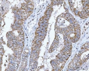 IHC staining of FFPE human endometrial adenocarcinoma tissue with RPL32 antibody. HIER: boil tissue sections in pH8 EDTA for 20 min and allow to cool before testing.