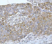 IHC staining of FFPE human esophageal squamous carcinoma tissue with RPL32 antibody. HIER: boil tissue sections in pH8 EDTA for 20 min and allow to cool before testing.