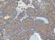 IHC staining of FFPE human breast cancer tissue with RPL32 antibody. HIER: boil tissue sections in pH8 EDTA for 20 min and allow to cool before testing.