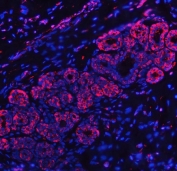 Immunofluorescent staining of FFPE human breast cancer tissue with RPL32 antibody (red) and DAPI nuclear stain (blue). HIER: steam section in pH6 citrate buffer for 20 min.