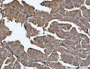 IHC staining of FFPE human lung adenocarcinoma tissue with VPS53 antibody. HIER: boil tissue sections in pH8 EDTA for 20 min and allow to cool before testing.