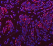Immunofluorescent staining of FFPE human breast cancer tissue with VPS53 antibody (red) and DAPI nuclear stain (blue). HIER: steam section in pH8 EDTA buffer for 20 min.