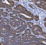 IHC staining of FFPE human colorectal adenocarcinoma tissue with NKCC1 antibody. HIER: boil tissue sections in pH8 EDTA for 20 min and allow to cool before testing.