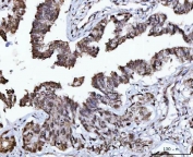 IHC staining of FFPE human lung adenocarcinoma tissue with USP26 antibody. HIER: boil tissue sections in pH8 EDTA for 20 min and allow to cool before testing.