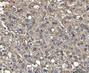 IHC staining of FFPE human liver cancer tissue with Malic enzyme 1 antibody. HIER: boil tissue sections in pH8 EDTA for 20 min and allow to cool before testing.