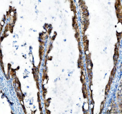 IHC staining of FFPE human ovarian cancer tissue with MST4 antibody. HIER: boil tissue sections in pH8 EDTA for 20 min and allow to cool before testing.