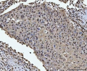 IHC staining of FFPE human esophageal squamous carcinoma tissue with HOXC4 antibody. HIER: boil tissue sections in pH8 EDTA for 20 min and allow to cool before testing.