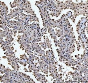 IHC staining of FFPE human lung cancer tissue with HOXC4 antibody. HIER: boil tissue sections in pH8 EDTA for 20 min and allow to cool before testing.