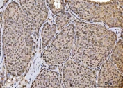 IHC staining of FFPE human breast cancer tissue with HOXC4 antibody. HIER: boil tissue sections in pH8 EDTA for 20 min and allow to cool before testing.