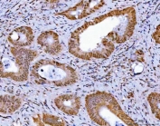 IHC staining of FFPE human colorectal adenocarcinoma tissue with GLIS1 antibody. HIER: boil tissue sections in pH8 EDTA for 20 min and allow to cool before testing.