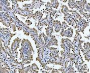 IHC staining of FFPE human lung cancer tissue with GLIS1 antibody. HIER: boil tissue sections in pH8 EDTA for 20 min and allow to cool before testing.