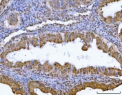 IHC staining of FFPE human ovarian cancer tissue with GLIS1 antibody. HIER: boil tissue sections in pH8 EDTA for 20 min and allow to cool before testing.