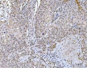IHC staining of FFPE human esophageal squamous carcinoma tissue with GLIS1 antibody. HIER: boil tissue sections in pH8 EDTA for 20 min and allow to cool before testing.