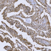 IHC staining of FFPE human lung adenocarcinoma tissue with ANXA10 antibody. HIER: boil tissue sections in pH8 EDTA for 20 min and allow to cool before testing.