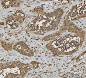 IHC staining of FFPE human appendiceal adenocarcinoma tissue with ANXA10 antibody. HIER: boil tissue sections in pH8 EDTA for 20 min and allow to cool before testing.