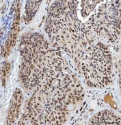 IHC staining of FFPE human lung squamous cell carcinoma tissue with X-ray repair cross-complementing 4 antibody. HIER: boil tissue sections in pH8 EDTA for 20 min and allow to cool before testing.