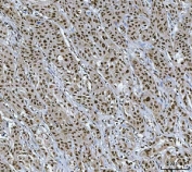 IHC staining of FFPE human breast duct carcinoma tissue with X-ray repair cross-complementing 4 antibody. HIER: boil tissue sections in pH8 EDTA for 20 min and allow to cool before testing.