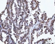 IHC staining of FFPE human ovarian cancer tissue with X-ray repair cross-complementing 4 antibody. HIER: boil tissue sections in pH8 EDTA for 20 min and allow to cool before testing.