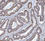 IHC staining of FFPE human colorectal adenocarcinoma tissue with X-ray repair cross-complementing 4 antibody. HIER: boil tissue sections in pH8 EDTA for 20 min and allow to cool before testing.
