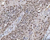 IHC staining of FFPE human penis squamous cell carcinoma tissue with X-ray repair cross-complementing 4 antibody. HIER: boil tissue sections in pH8 EDTA for 20 min and allow to cool before testing.