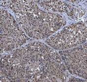 IHC staining of FFPE human liver cancer tissue with X-ray repair cross-complementing 4 antibody. HIER: boil tissue sections in pH8 EDTA for 20 min and allow to cool before testing.
