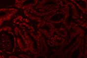 Immunofluorescent staining of FFPE human colorectal adenocarcinoma tissue with X-ray repair cross-complementing 4 antibody. HIER: boil tissue sections in pH8 EDTA for 20 min and allow to cool before testing.