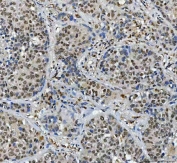 IHC staining of FFPE human liver cancer tissue with PSF antibody. HIER: boil tissue sections in pH8 EDTA for 20 min and allow to cool before testing.