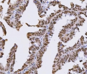 IHC staining of FFPE human ovarian cancer tissue with PSF antibody. HIER: boil tissue sections in pH8 EDTA for 20 min and allow to cool before testing.