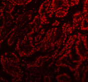 Immunofluorescent staining of FFPE human lung cancer tissue with PSF antibody (red). HIER: steam section in pH8 EDTA buffer for 20 min.