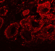 Immunofluorescent staining of FFPE human colon cancer tissue with PSF antibody (red). HIER: steam section in pH8 EDTA buffer for 20 min.