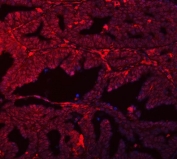 Immunofluorescent staining of FFPE human ovarian cancer tissue with PSF antibody (red) and DAPI nuclear stain (blue). HIER: steam section in pH8 EDTA buffer for 20 min.