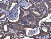 IHC staining of FFPE human colorectal adenocarcinoma tissue with Sirtuin 5 antibody. HIER: boil tissue sections in pH8 EDTA for 20 min and allow to cool before testing.