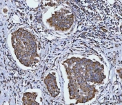IHC staining of FFPE human breast cancer tissue with Sirtuin 5 antibody. HIER: boil tissue sections in pH8 EDTA for 20 min and allow to cool before testing.