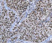 IHC staining of FFPE human lung squamous cell carcinoma tissue with UBE2N antibody. HIER: boil tissue sections in pH8 EDTA for 20 min and allow to cool before testing.