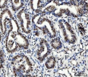 IHC staining of FFPE human cervical cancer tissue with UBE2N antibody. HIER: boil tissue sections in pH8 EDTA for 20 min and allow to cool before testing.